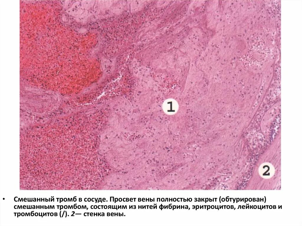 Организованный тромб в Вене микропрепарат. Красный обтурирующий тромб микропрепарат. Красный тромб в Вене микропрепарат. Смешанный тромб в Вене микропрепарат рисунок. Тромб микропрепарат