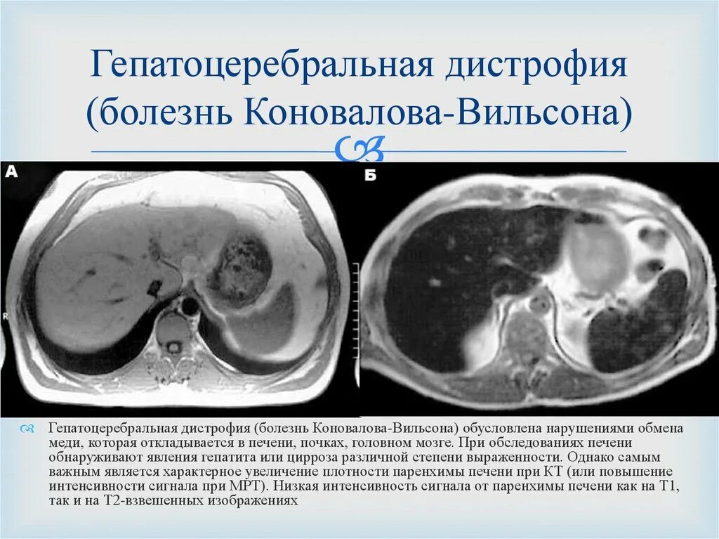 Болезнь Вильсона Коновалова мрт головного мозга. Вильсона -Коновалова гепатолентикулярная дегенерация. Болезнь Вильсона Коновалова печень мрт. Болезнь Коновалова Вильсона кт головного мозга.