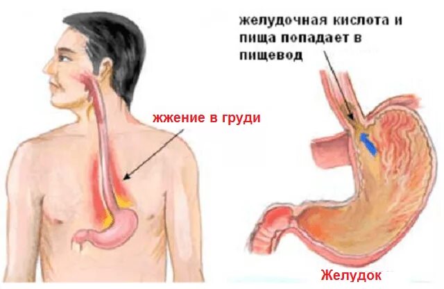 Жжение жкт. Жжение в желудке и изжога.