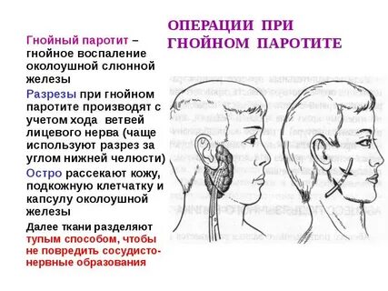 Операция на околоушные железы