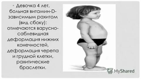 Рахит у детей грудная клетка