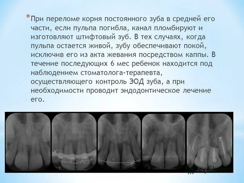 Продольный перелом корня зуба. Оскольчатый перелом корня зуба. Перелом корня зуба рентген. Перелом корня постоянного зуба.