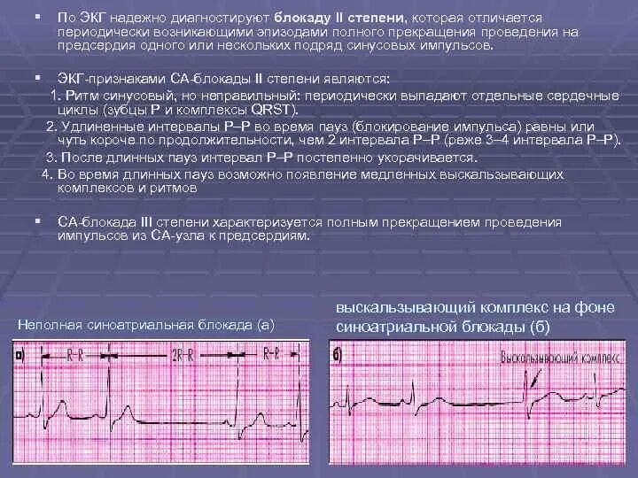 Что означает блокада сердца. Экг-признаком полной синоаурикулярной блокады. экг внутрипредсердная блокада av блокада 2 степени. са блокада экг критерии. нарушения ритма экг блокады.