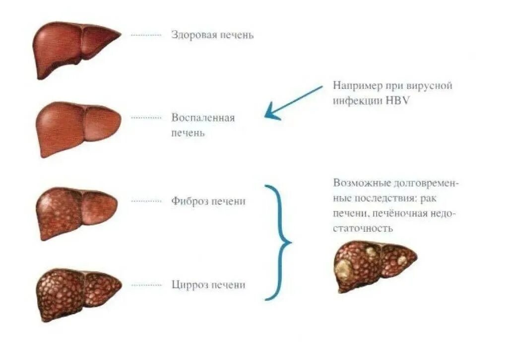 Стадии гепатита печени