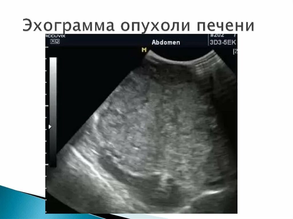 ультразвуковое исследование при патологии печени. холангиоцеллюлярная карцинома печени узи. узи поражения печени. хронический гепатит узи картина. узи исследование желчного пузыря.