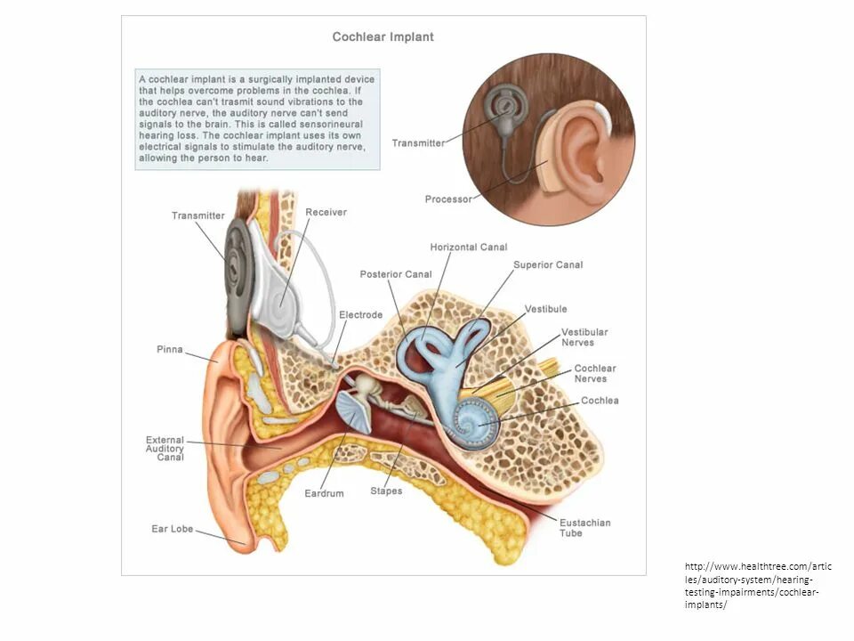 Аппарат Cochlear кохлеарный Cochlear. Кохлеарный имплант кохлеар. Vestibular-Cochlear nerve. Hear system