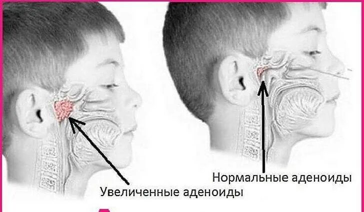 Аденоидные вегетации 1. Аденоиды носоглотки 2 степени. Adenoid 3 stepeni. Аоеноилы 3 степер.