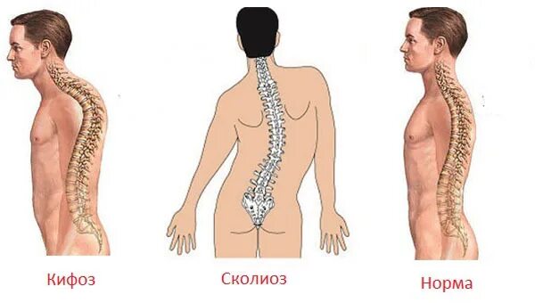 Кифоз шейно грудного отдела позвоночника. Деформация грудной клетки кифоз. Кифоз шейного отдела 3 степени. Кифосколиоз грудного отдела позвоночника 2.