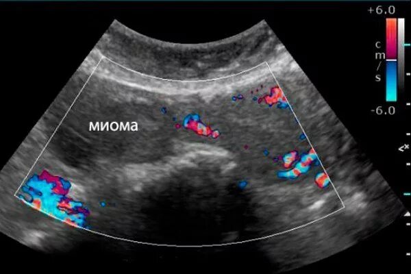 Допплерография некроза миоматозного узла. Миома матки допплерография.