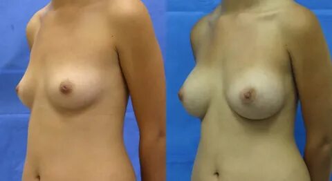 Slideshow does tummy tuck pull boobs tits down.