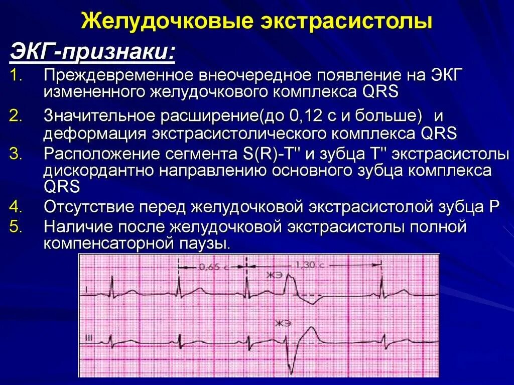 Частые желудочковые экстрасистолы