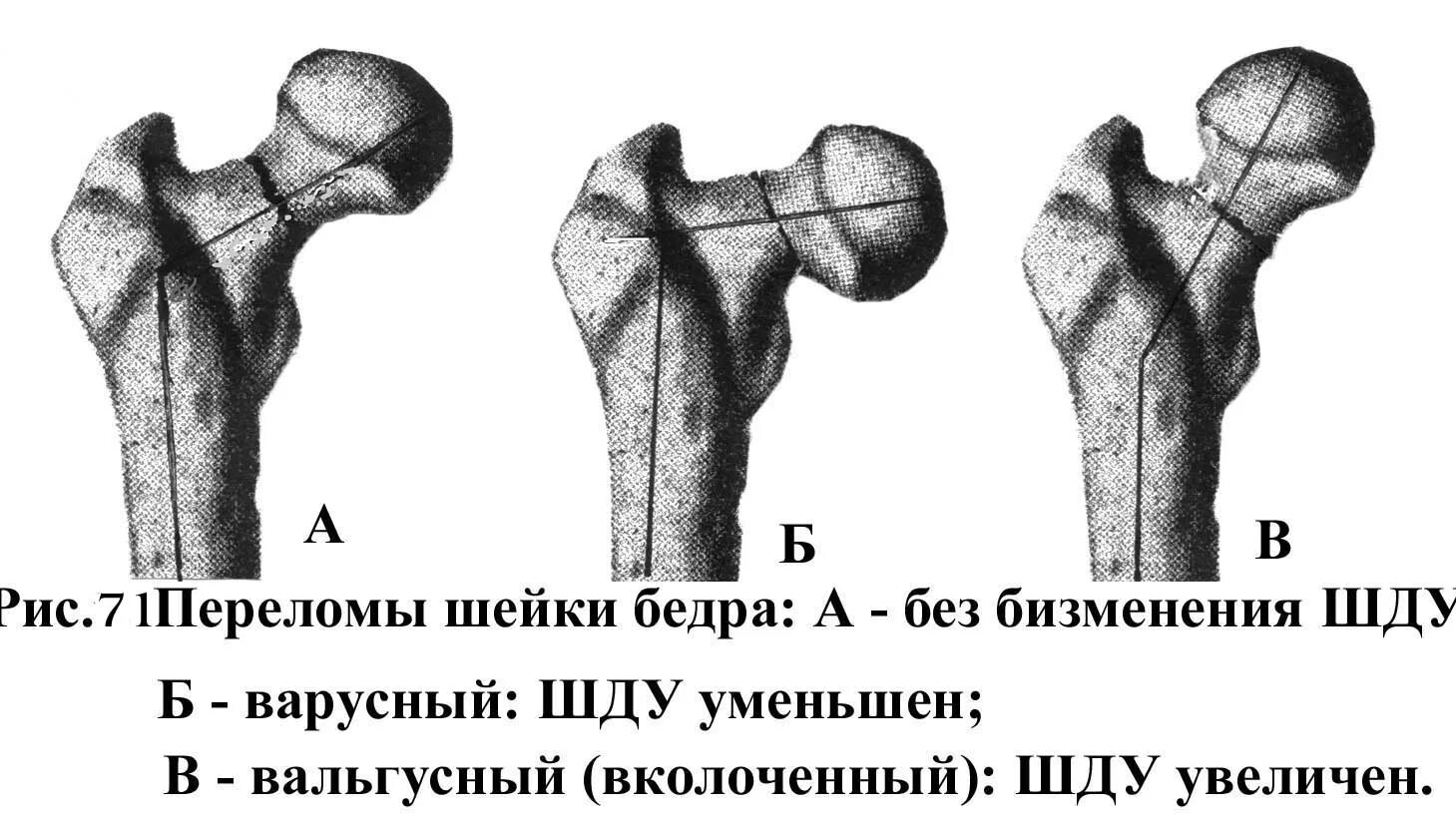 Аддукционный перелом шейки бедренной кости. Аддукционные переломы шейки бедра. Варусный перелом шейки бедренной кости. Варусный перелом шейки бедра механизм. Трещина шейки