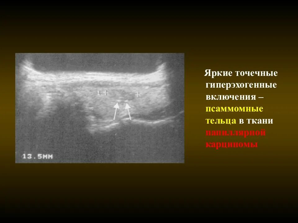 Гиперэхогенные точечные включения. Псаммомные тельца щитовидной железы. Гиперэхогенные включения в щитовидке это. Гиперэхогенная щитовидная железа.