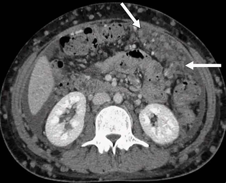 Peritoneal carcinomatosis in a 30-year-old woman with malignant... Download Scie