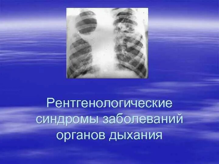 Рентгенологические синдромы. Рентгенологические синдромы заболеваний легких. Рентгенологические синдромы поражения легких. Основные рентгенологические синдромы болезней лёгких. Рентгенологические синдромы легких