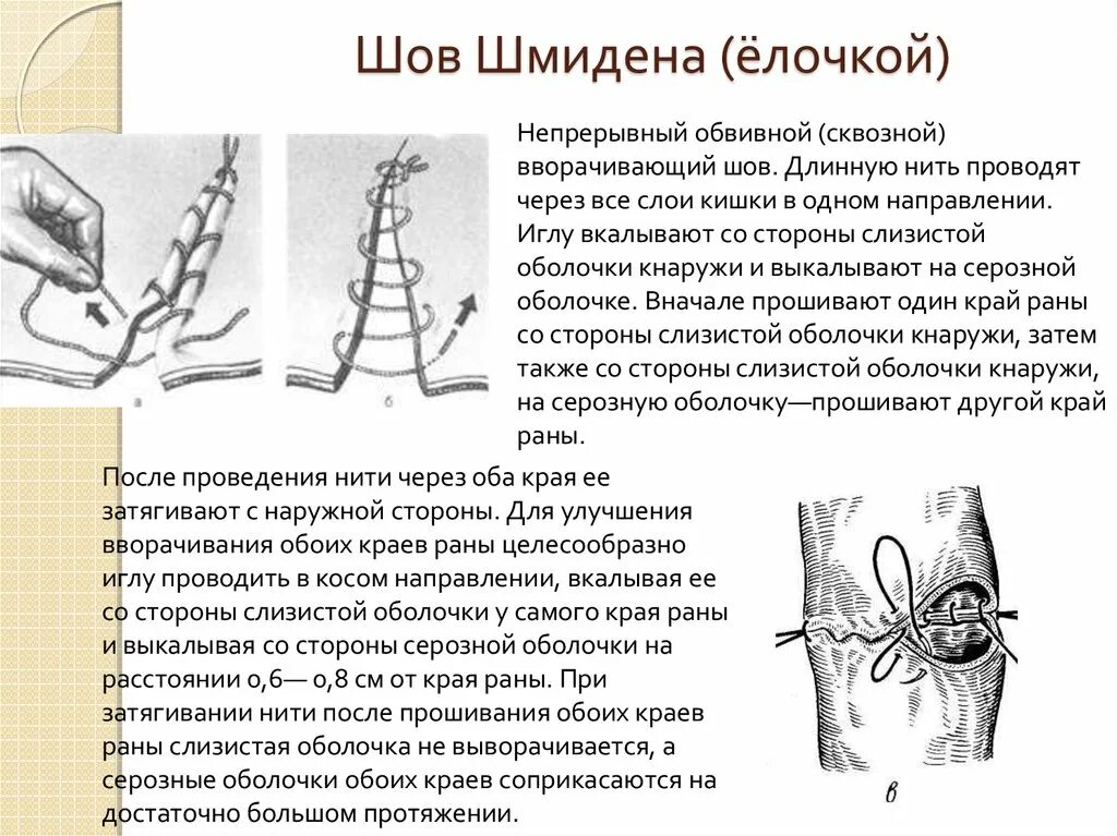 Схема кишечного шва Шмидена. Непрерывный обвивной вворачивающий шов "елочкой" Шмидена. Техника наложения непрерывного обвивного шва. Вворачивающий Скорняжный шов Шмидена. Как называется шов после операции