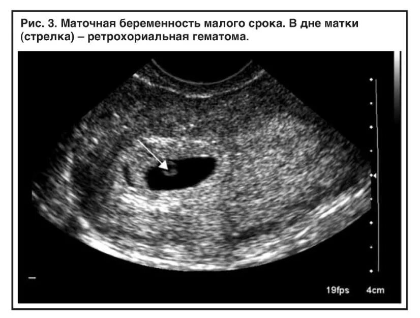 Гематома 6 недель. УЗИ признаки ретрохориальной гематомы. УЗИ 6 недель беременности отслойка плодного яйца. Гематома на УЗИ В 8 недель беременности.