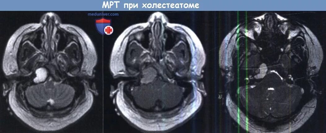 Мрт височных костей в режиме dwi. Холестеатома височной кости мрт. non epi dwi мрт. холестеатома верхушки пирамиды височной кости мрт. холестеатома на кт височных.