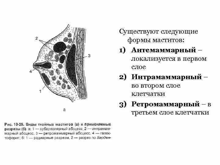 Ретромаммарный Гнойный мастит. Мастит классификация по локализации. Локализации Гнойного мастита:. Острый гнойный мастит