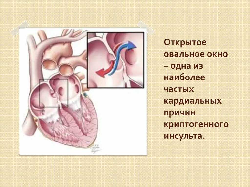 Окно в сердце у новорожденного. Заращение овального окна. овальное окно в сердце. незаращение овального окна. открытое овальное окошечко.