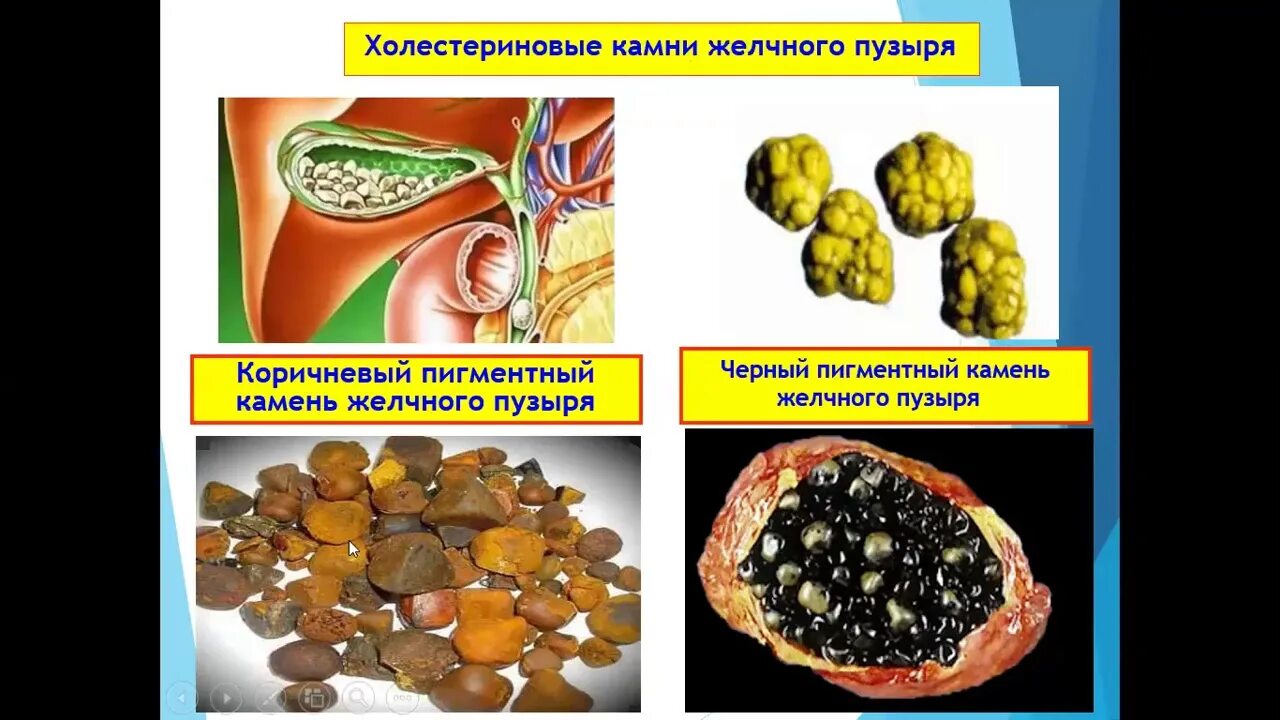 Жкб хирургия. Острый калькулезный холецистит и желчекаменная болезнь. ЖКБ острый калькулезный холецистит. Камни желчного пузыря патанатомия. Калькулезный холецистит макропрепарат.