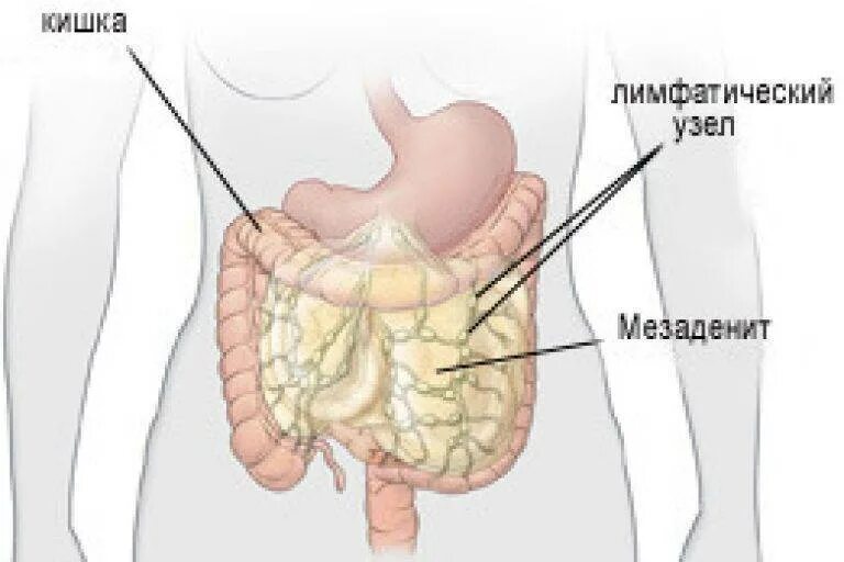Лимфатические узлы в кишечнике. Мезаденит (лимфаденит мезентериальный). Брыжейка кишечника мезаденит. Острый неспецифический брыжеечный мезаденит. Неспецифический брыжеечный мезаденит.