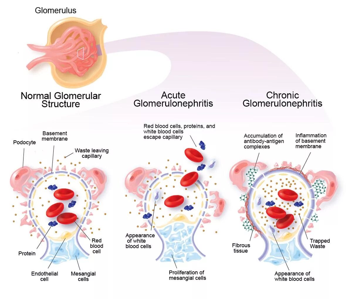 Гломерулонефритом страдают. Механизм развития хронического гломерулонефрита. Острый подострый хронический гломерулонефрит. Патогенез острого гломерулонефрита картинки. Поражение клубочков гломерулонефрит.
