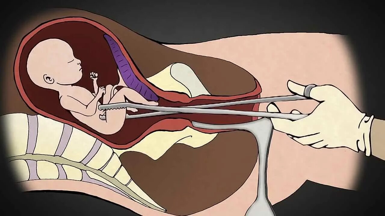 Схватки 18. Хирургический аборт на поздних сроках. Инструментальный аборт. Искусственное прерывание родов.