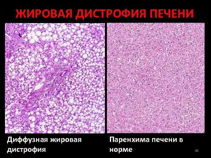 Липидоз печени. Жировая дистрофия печени микропрепарат. жировая дистрофия печени гистология. жировая инфильтрация печени патанатомия. жировая дистрофия печени это в патологии.