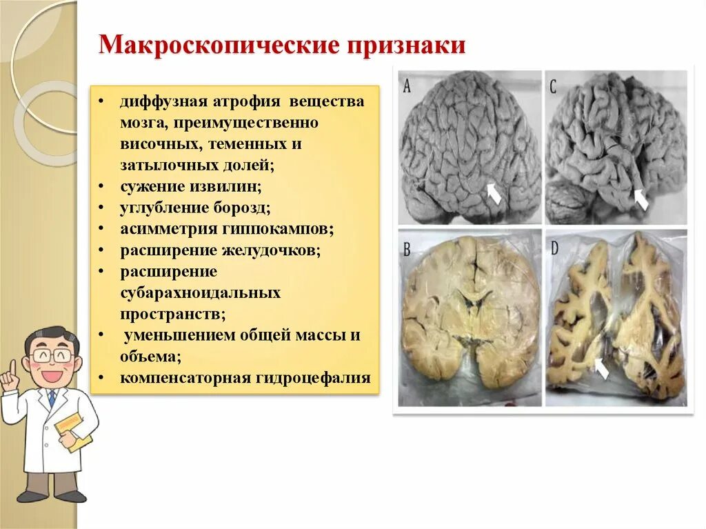 Макроскопические признаки. Макроскопические признаки атрофии. Макроскопические признаки некроза. Диффузная атрофия вещества мозга. Диффузная атрофия головного мозга