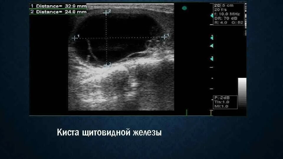 Коллоидные кисты щитовидной железы на УЗИ. Кистозные образования в щитовидной железе по УЗИ. Микрокиста щитовидной железы. Кистозный узел щитовидной железы на УЗИ. Киста щитовидной у мужчин