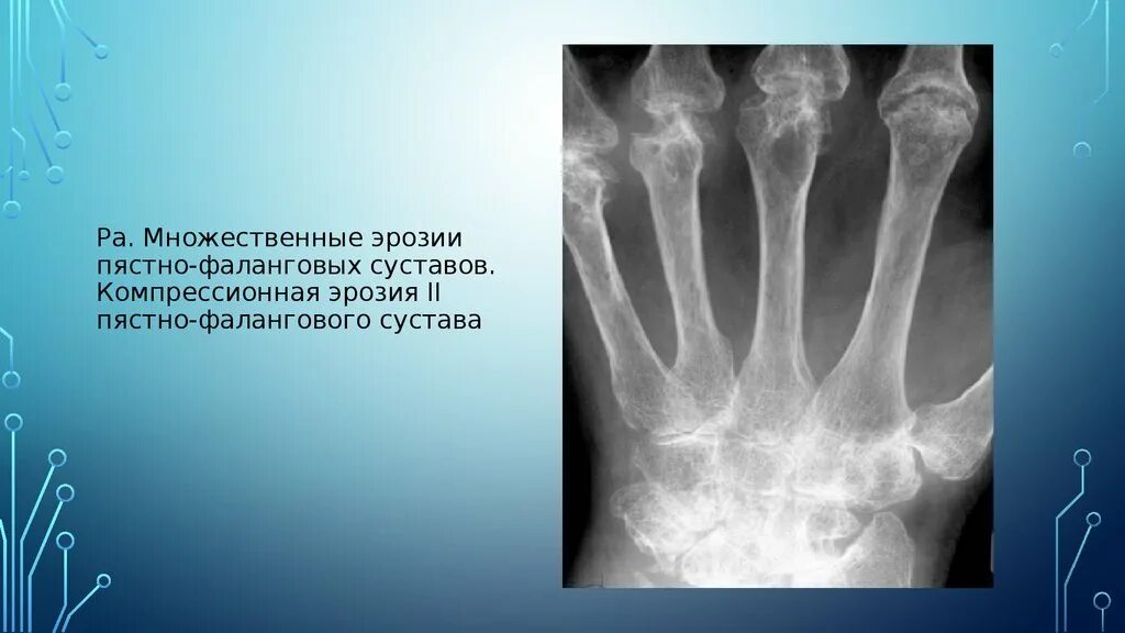 1 пястно-фаланговый сустав. Артроз пястно фалангового сустава. Ревматоидный артрит запястного сустава. Артрит пястно-фалангового сустава кисти. Артроз пястно фалангового сустава.