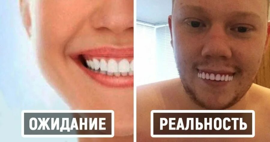 Жестокая реальность. Виниры ожидание и реальность. ожидание и реальность зубы. голливудская улыбка ожидание и реальность. накладки на зубы ожидание реальность.
