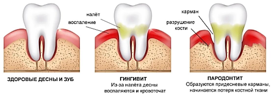 Как отличить зубную боль от воспаления. Периодонтит воспаление десны. Воспалилась Десна парадонтит. Воспаление десен пародонтит. Воспалилась Десна и кровоточит.