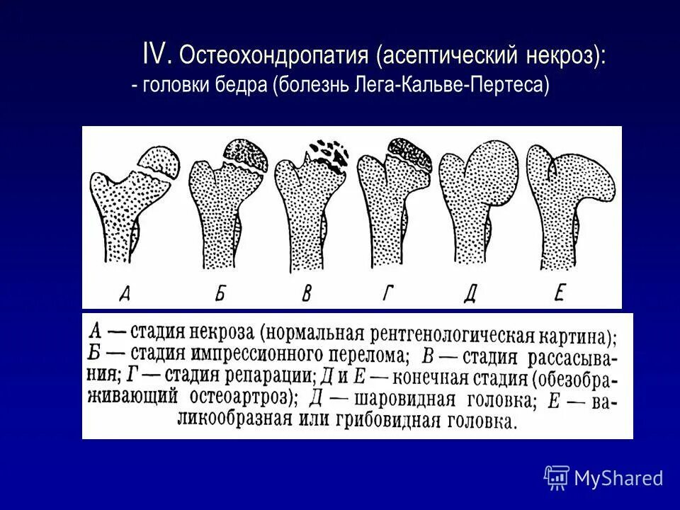 некроз кости 3 степени. рентген асептический некроз бедренной кости. некроз кости 3 степени. асептический некроз 1 стадии мрт. асептический некроз головки бедренной кости кт.