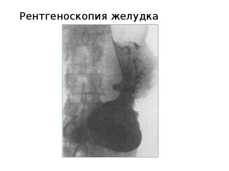Рентгеноскопия пищевода и желудка с барием. Рентген желудка тренделенбурга. рентген пищевода и желудка в положении тренделенбурга. рентген желудка по тренделенбургу. рентген желудка в положении тренделенбурга.