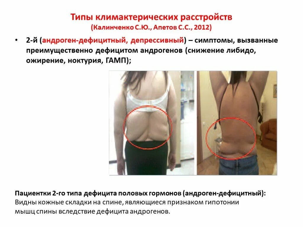 андрогены у женщин симптомы