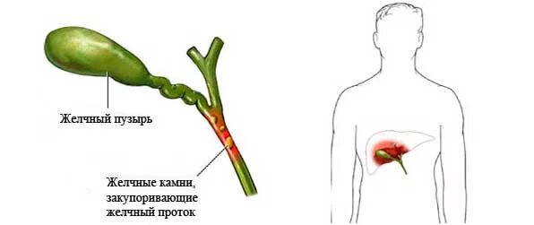 Желчный пузырь мясников