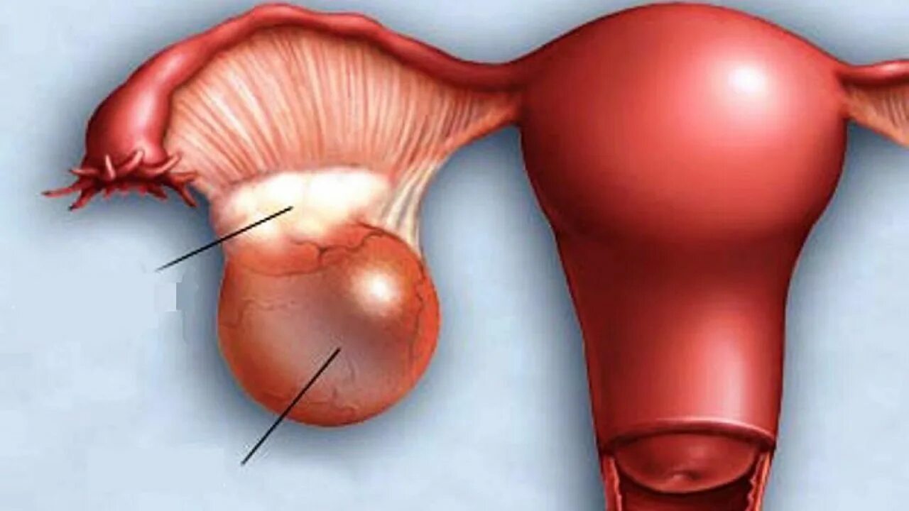 Образование округлое в яичнике