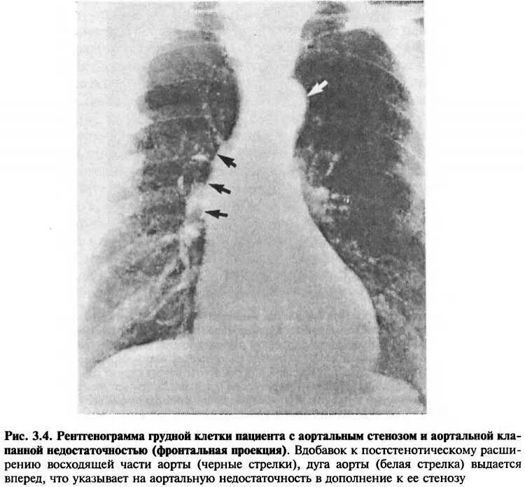 Стеноз грудной клетки. Расширение тени сердца на рентгенограмме. Стеноз грудной клетки. Митральный стеноз рентгенография. Стеноз аортального клапана рентгенограмма.