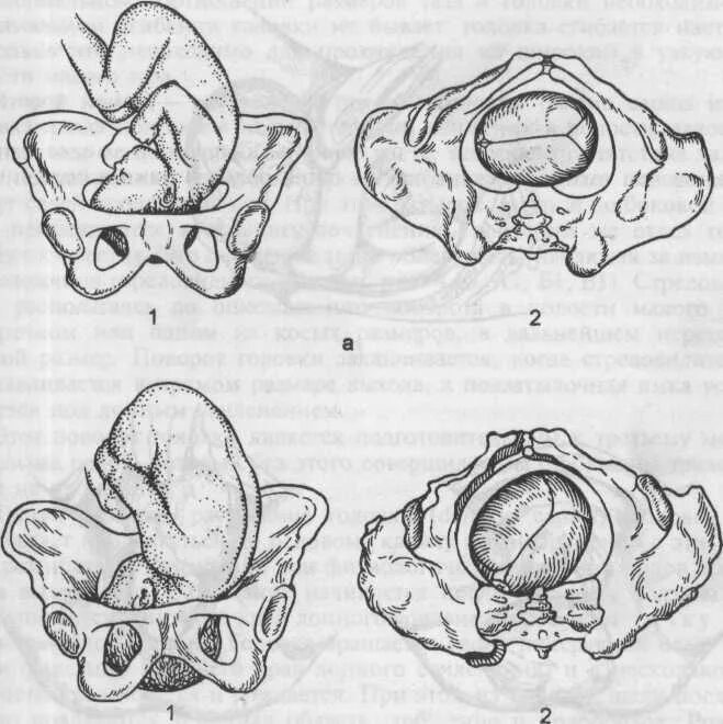 Кесарево узкий таз. Затылочное предлежание 2 позиция задний вид. 1 Позиция передний вид затылочного предлежания. Общеравномерносуженный таз биомеханизм родов. Передний и задний вид затылочного предлежания.