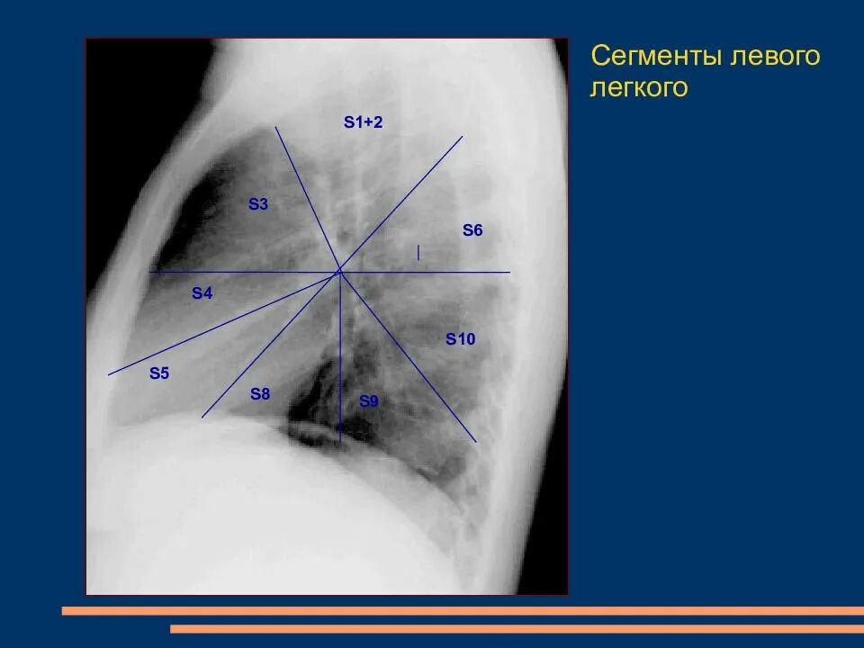 S10 легкого. S10 легкие сегмент. 6, 10 сегмент правого легкого. S10 легкого. S10 сегмент левого легкого.