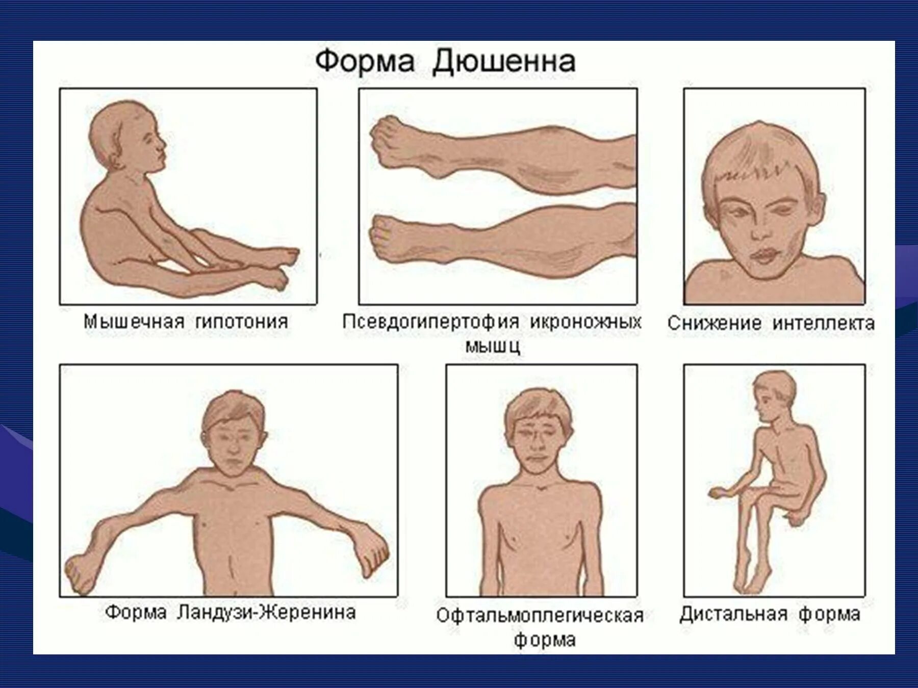 Мышечная дистрофия Дюшенна лекарство. Мышечная дистрофия Дюшенна клинические проявления.