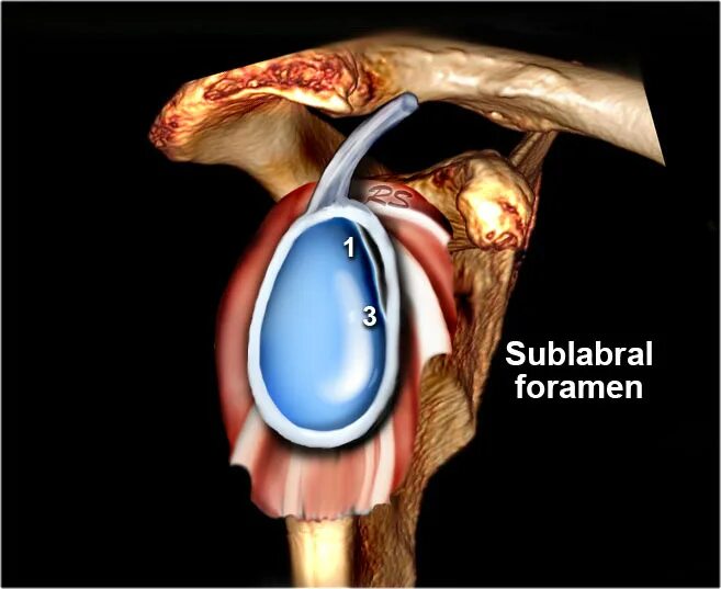 Суставная губа гленоида плечевого сустава. Сублабральное отверстие плечевого сустава мрт. Суставная губа плечевого сустава анатомия. Разрыв губы гленоида