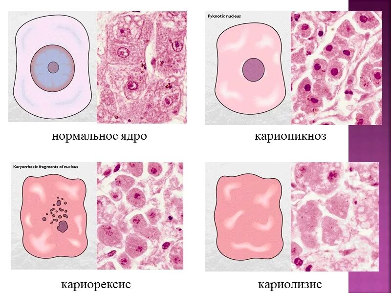 Кариопикноз это. Кариопикноз гистология. Некроз кариопикноз. Кариорексис кариолизис. Дистрофия эпителия гистология.