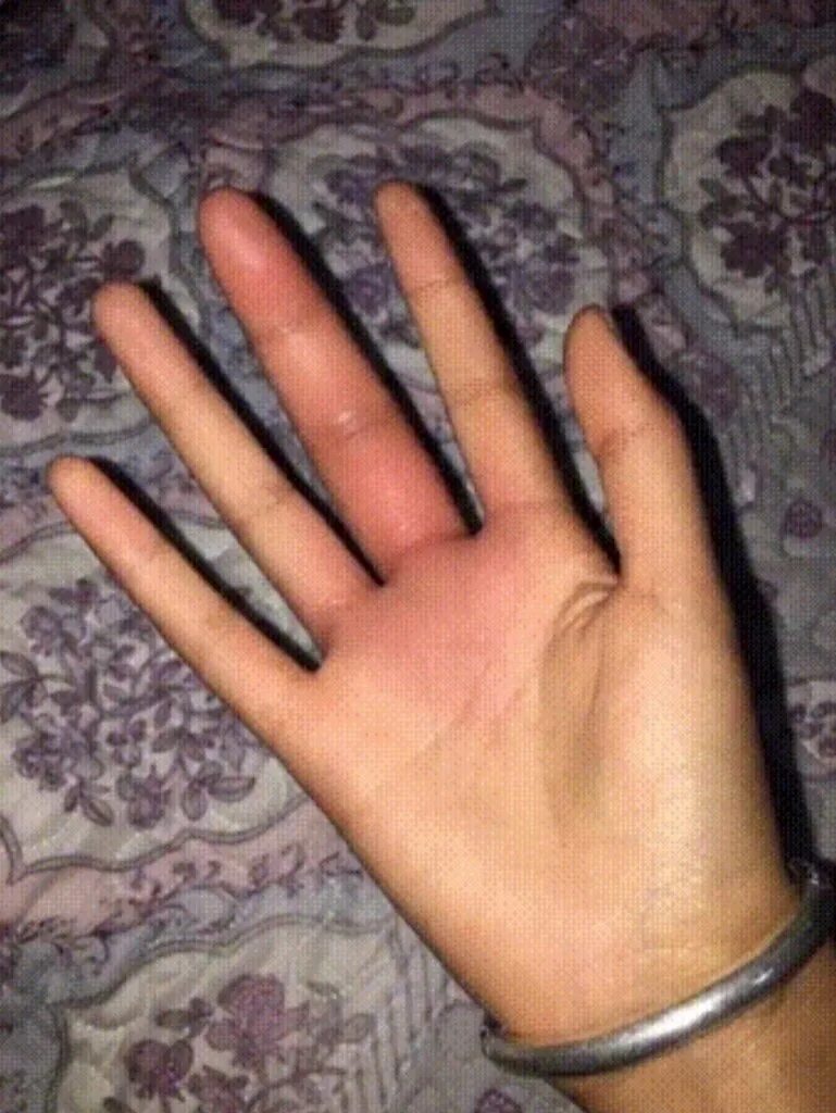 перелом среднего пальца. перелом второй фаланги безымянного пальца. травмы безымянного пальца. вывих большого пальца (1 пястно-фалангового сустава). травмы безымянного пальца.