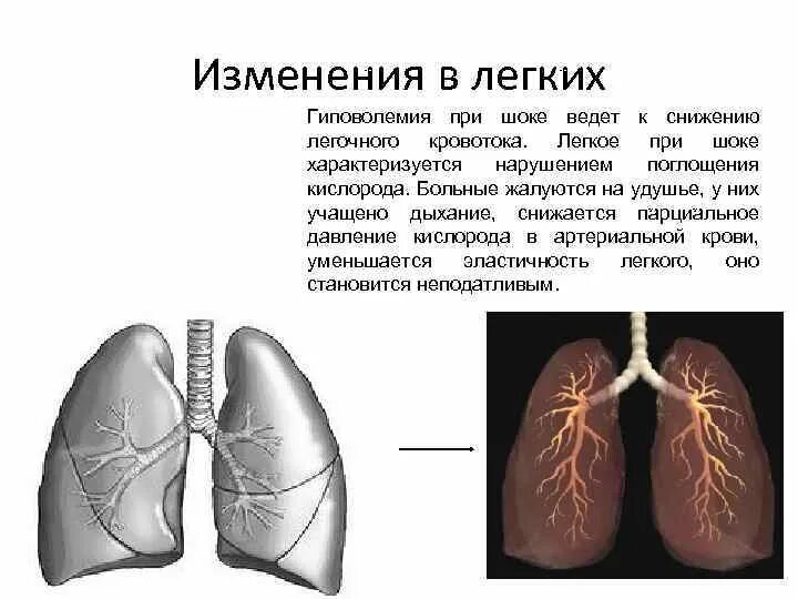 Физиологические изменения в легких. Изменения в легких при шоке.