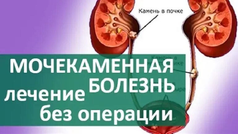 Камни в почках заболевание. Мочекамеменная болезнь. Мочекаменная болезнь камни. Мочекаменная болезнь терапия.