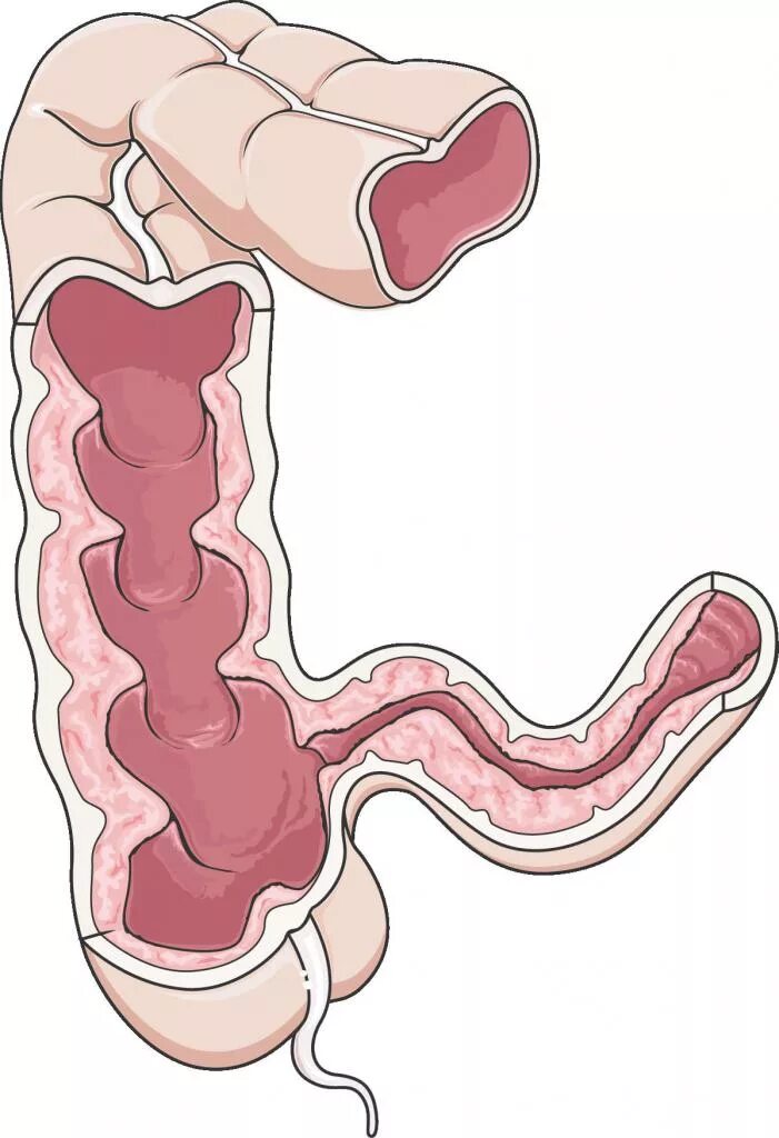 Спазмированный кишечник. Спазм Толстого кишечника.