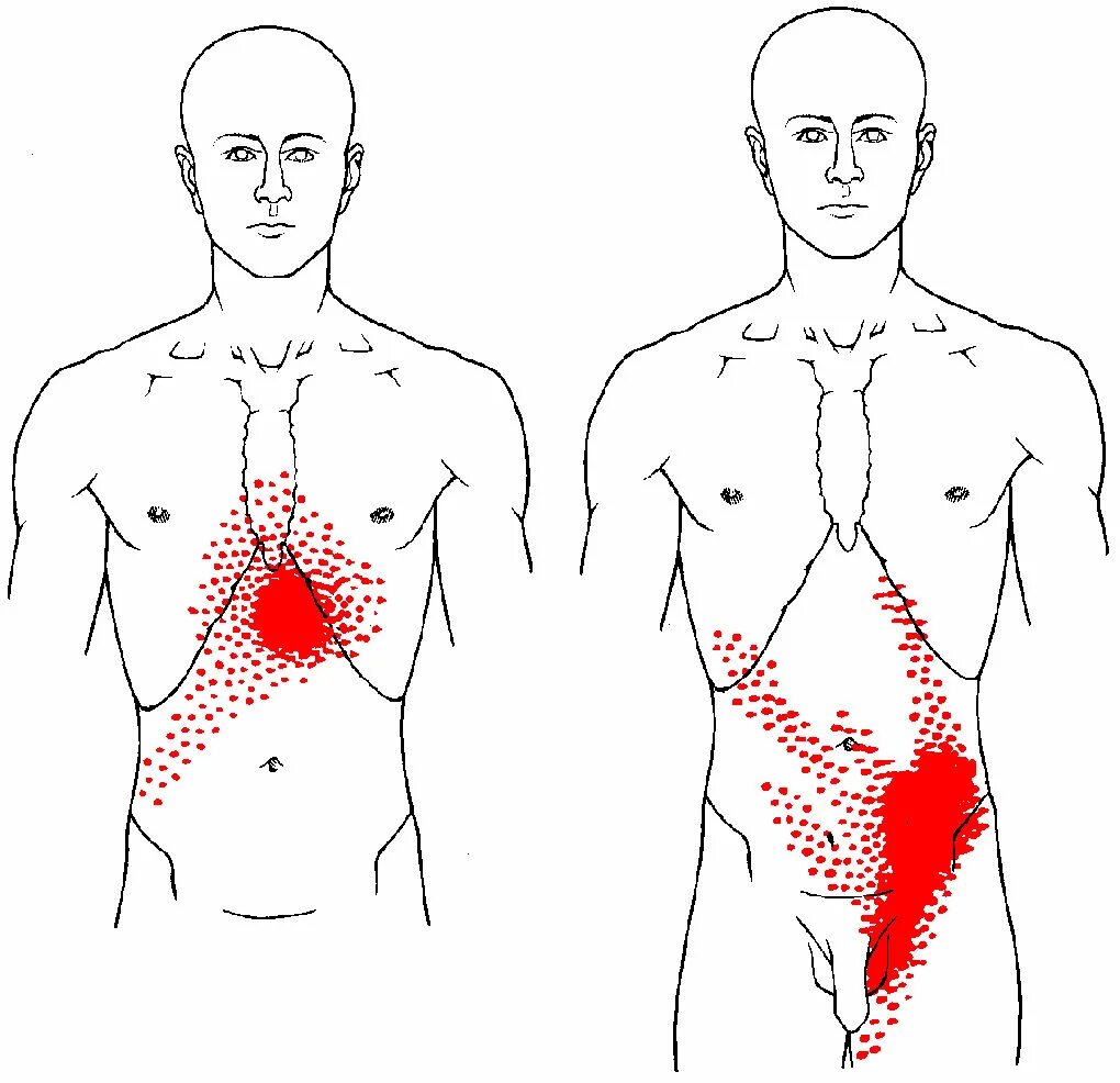Триггерные точки мышц живота. Фибромиалгия триггерные точки схема. Миофасциальные болевые триггерные точки тела человека. Карта триггерных точек в мышцах.